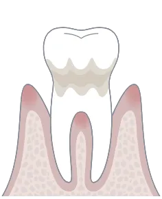歯周病軽度