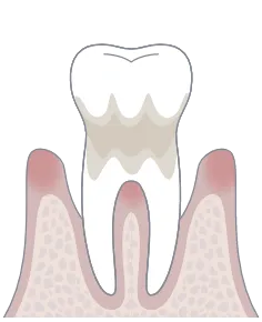 歯周病中度