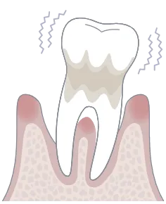 歯周病重度