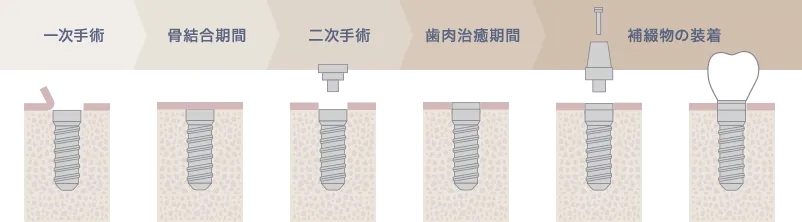 インプラントの手術方法